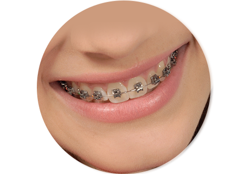 Alinhador ortodôntico Invisível, tendência na ortodontia moderna